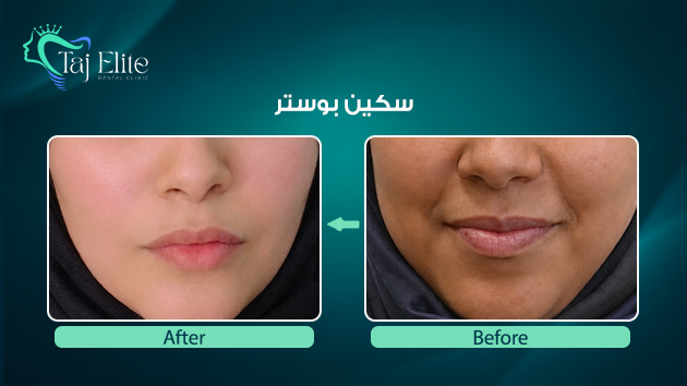 before-^-after.6